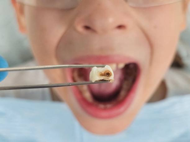 Best Emergency Root Canal Treatment in Endicott, NY